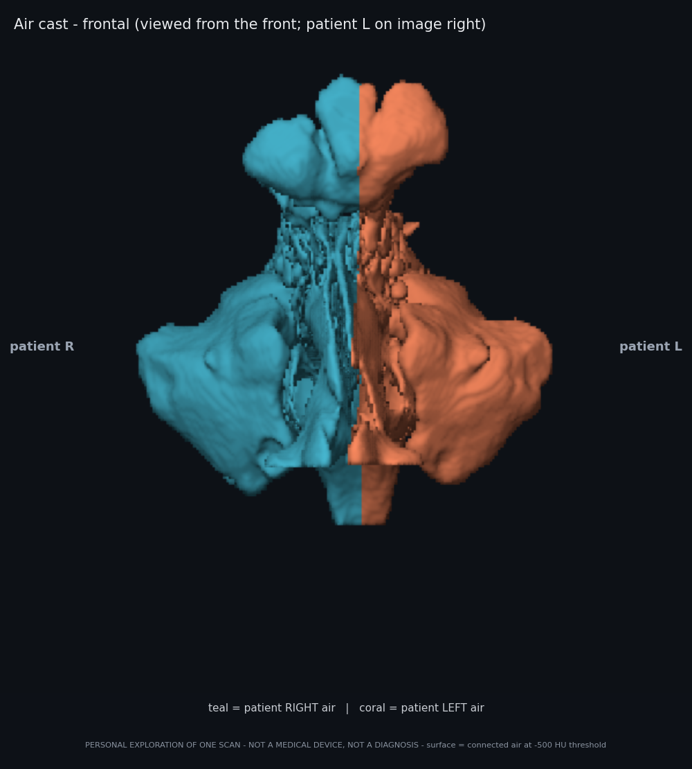 Frontal view of air cast