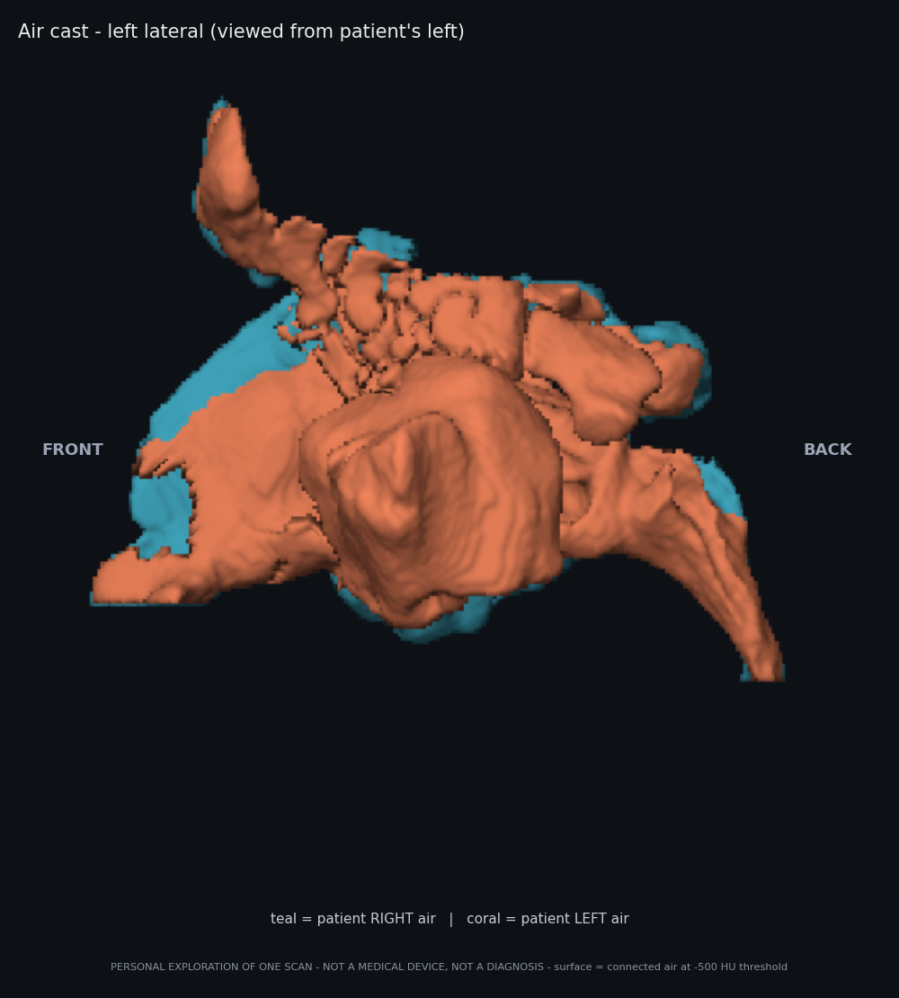 Left lateral view of air cast