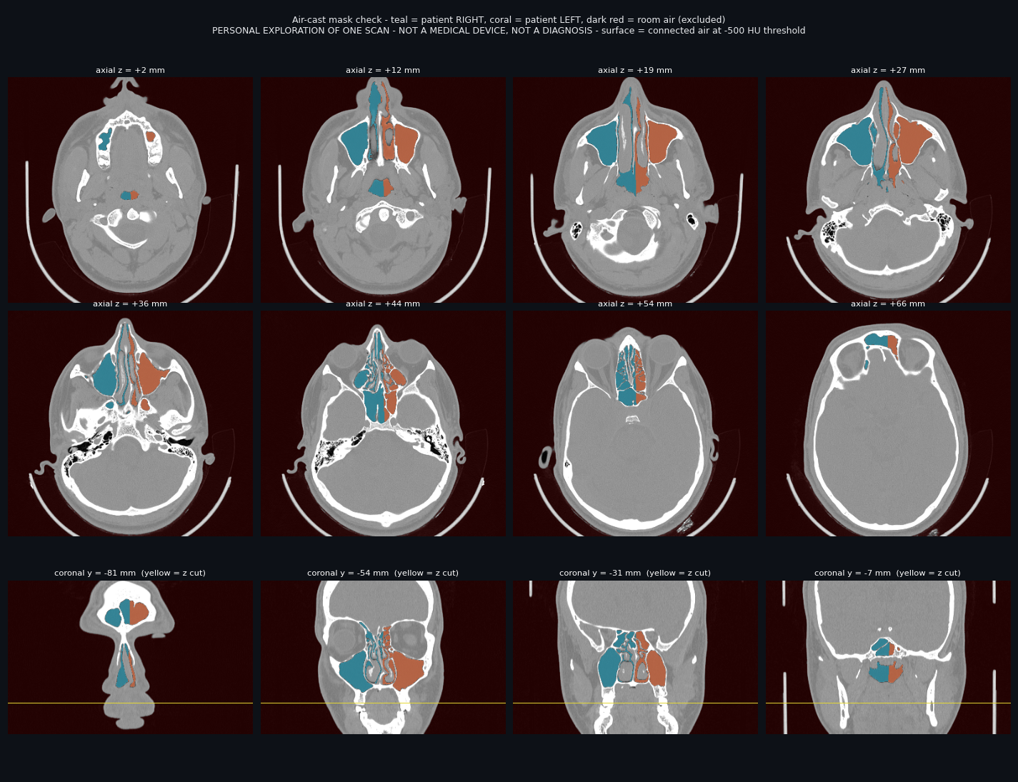 Air mask overlaid on axial and coronal CT slices