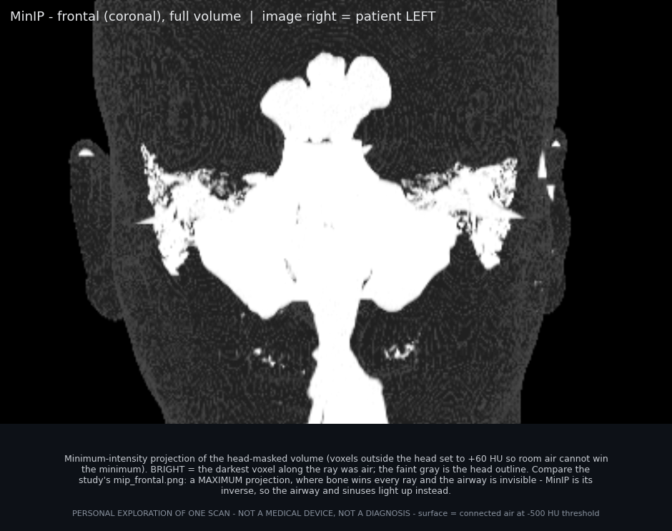 Coronal MinIP