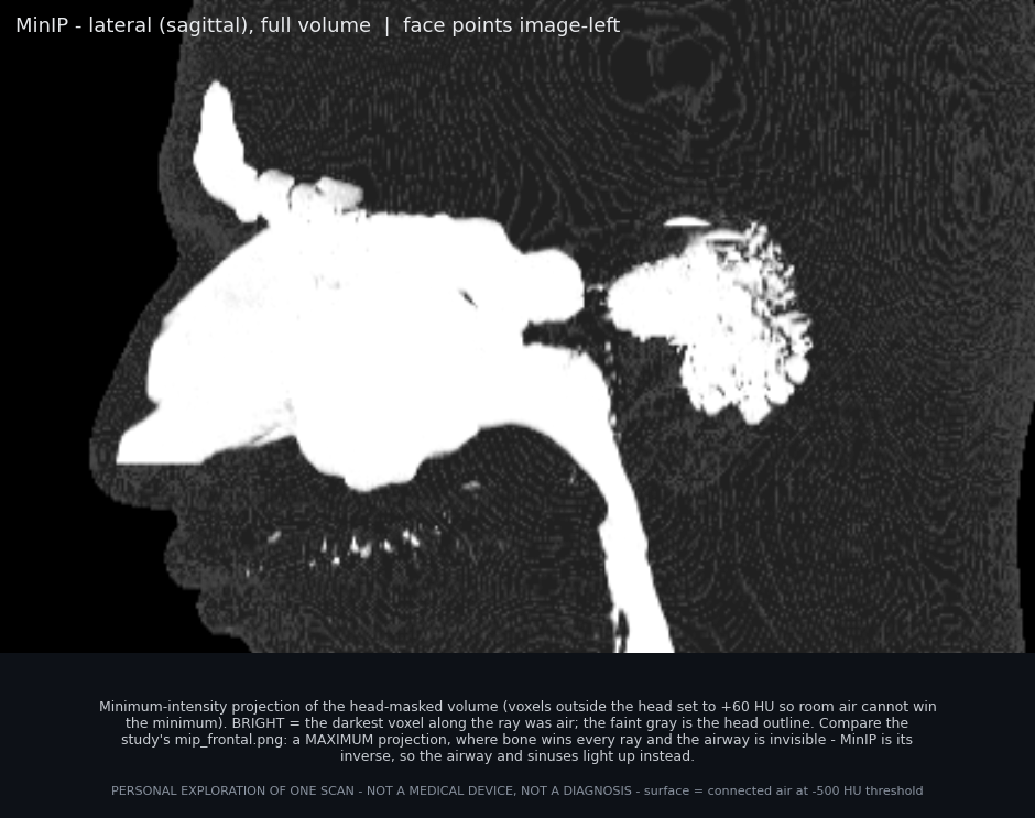 Sagittal MinIP