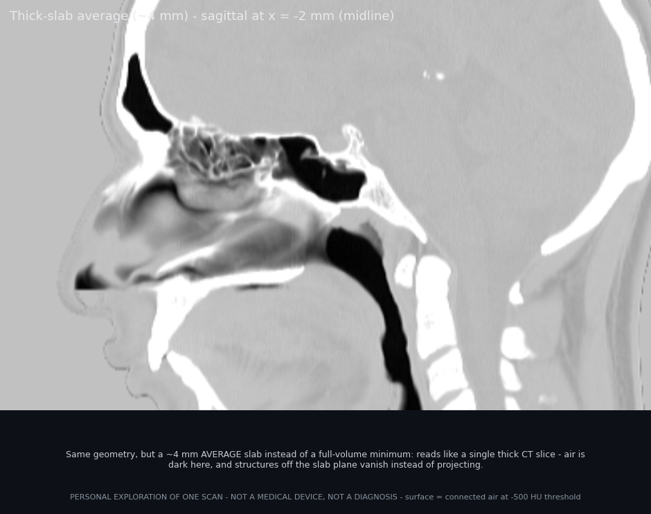 Sagittal thick-slab average